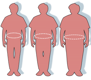 Weight loss surgery