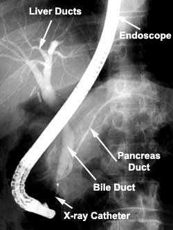 Endoscopic Retrograde Cholangio-pancreatography