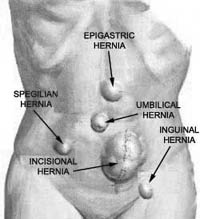 Locations of several types of hernia