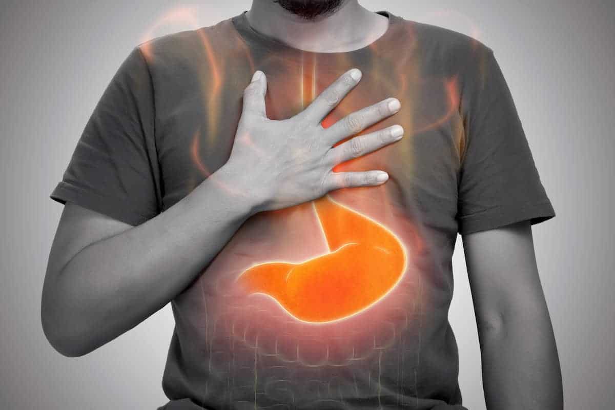 I Have Reflux. Is the Gastric Sleeve or Bypass Better for Me?