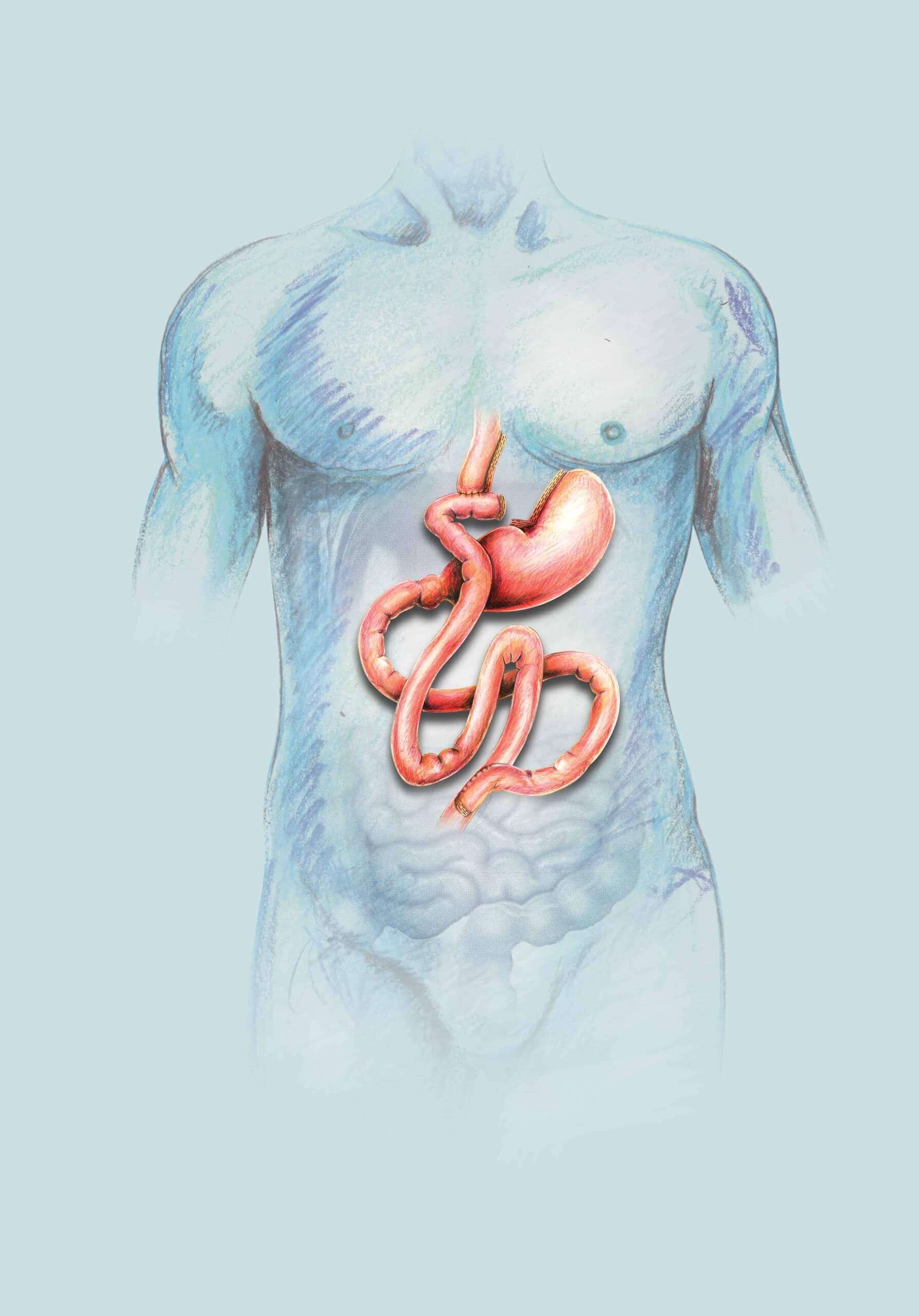 Navigating Gastric Bypass Surgery Options: What You Need to Know