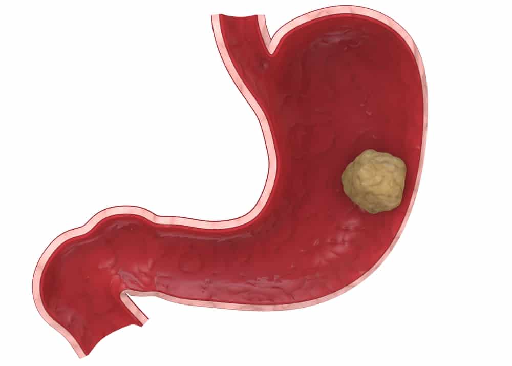 Illustration of Gastric Cancer in a stomach