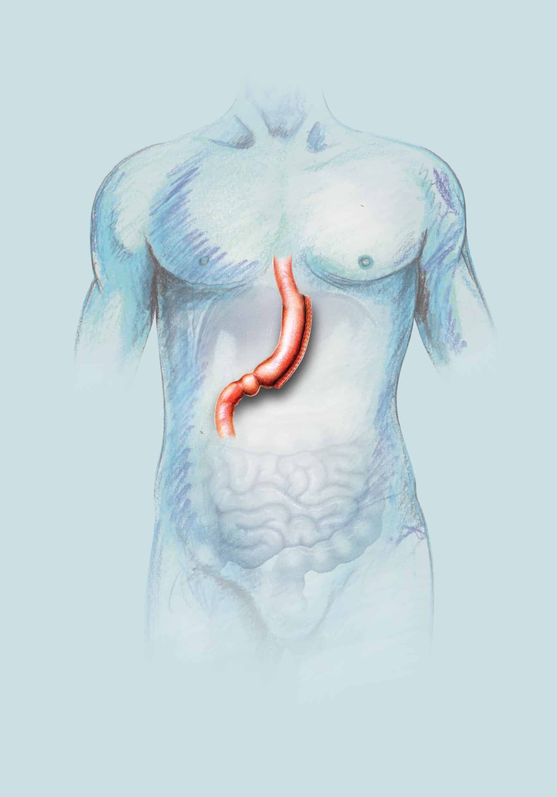 Gastric Sleeve Revision Surgery: What Are the Options?